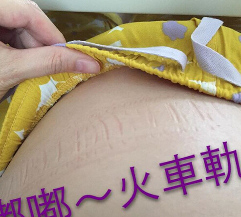 徐若瑄怀孕五月卧床待产 肚皮现勒痕