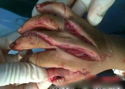 河南5岁男童被继母砍30多刀 继母7月被确诊胃癌晚期