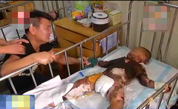 留守男童掉进开水盆 奶奶土法治疗抹碱致其全身发黑
