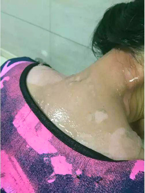 哺乳期妈妈吃火锅要求加汤 服务员将滚汤浇其头上