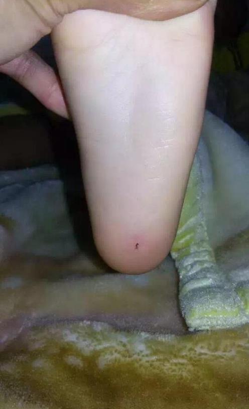 云南个旧4岁男童脚底被残忍插入2厘米牙签 警方已立案