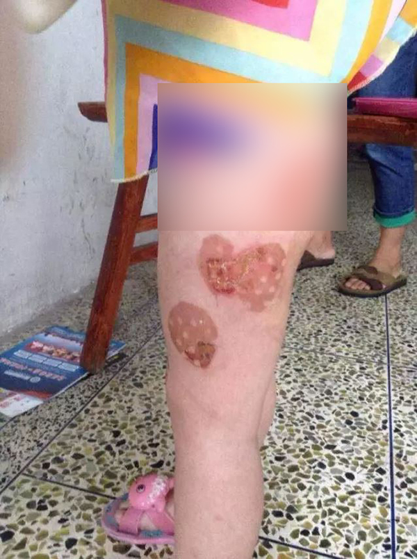4岁女童遭父亲虐待双腿被灼烫流脓 记者采访被殴打
