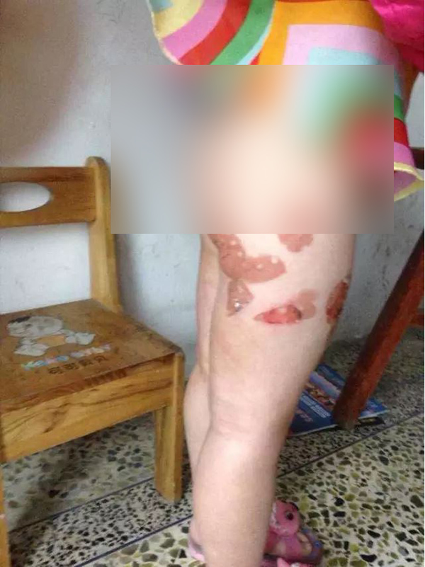 4岁女童遭父亲虐待双腿被灼烫流脓 记者采访被殴打