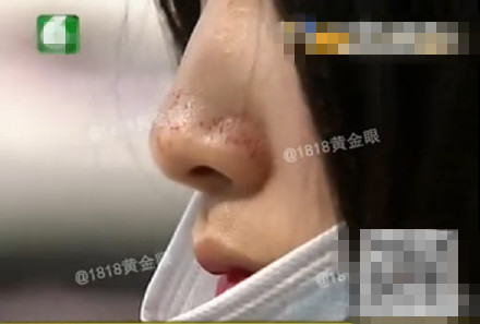 杭州一女子去黑头花1500元 美发店称一颗20元