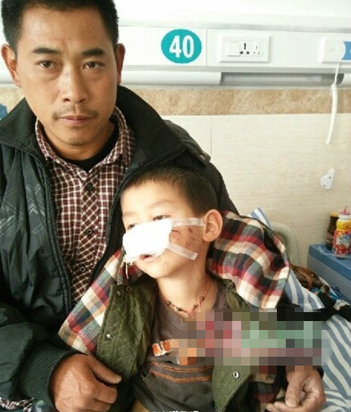 江西5岁男童鼻尖被狗咬下 因缺钱鼻梁仍用药水保存