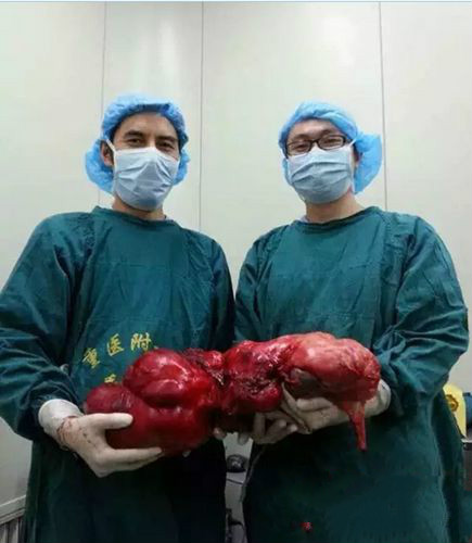 老人腹胀 检查发现肚子里长18斤肉瘤